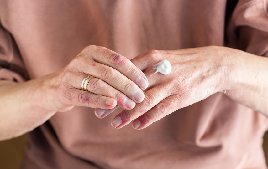 Dermatitis hands needing salt therapy at Salt Room Winter Haven in FL