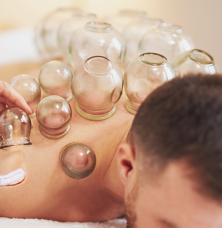 Cupping therapy in Winter Haven Florida